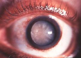 Oeil atteint de Cataracte