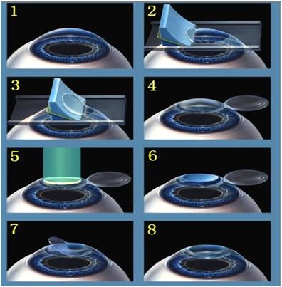 Opration laser